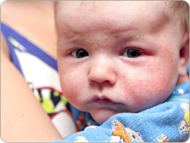 eczema_baby_BRAND_PHO_EN eczema_baby_BRAND_PHO_EN