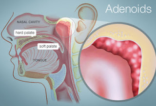 493x335_adenoids 493x335_adenoids