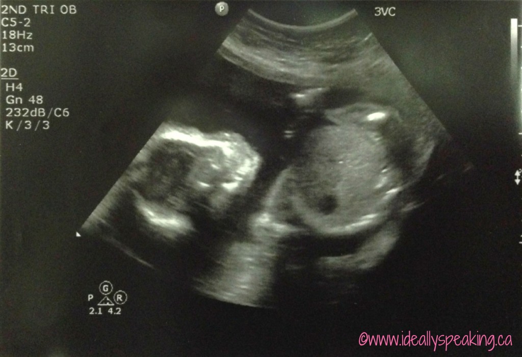 Ultrasound-Its-A-Boy Ultrasound-Its-A-Boy