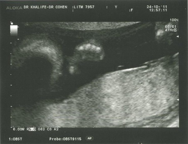 21-week-scan-2-3-3-600x459