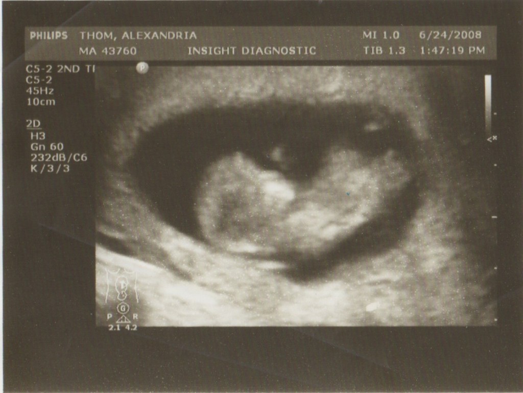 Marshmallow-Ultrasound Marshmallow-Ultrasound
