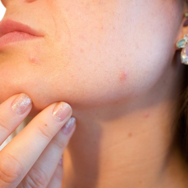 acne-1606765_960_720-600x600 acne-1606765_960_720-600x600