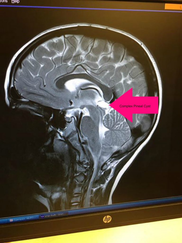 complex pineal cyst