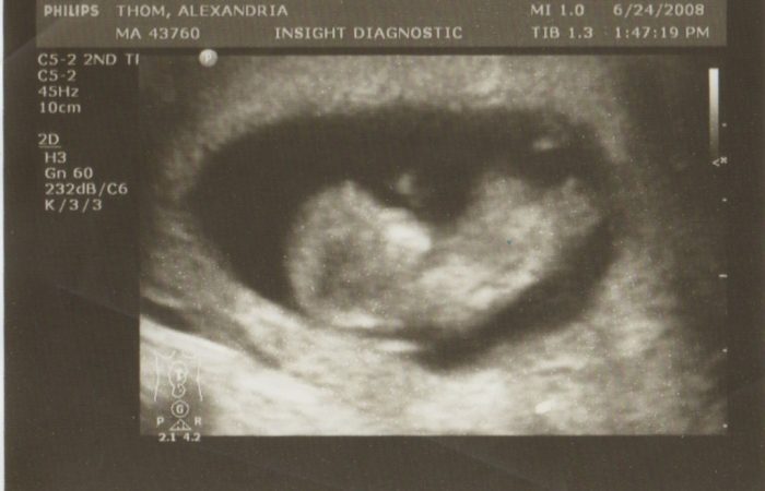 ultrasound-e1344550575726-1024x769