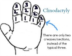 clinodactyly