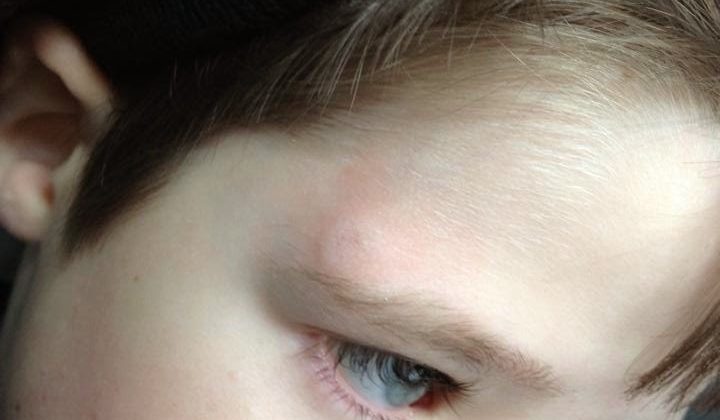 headinjury
