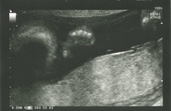21-week-scan-2-3-3-600x459