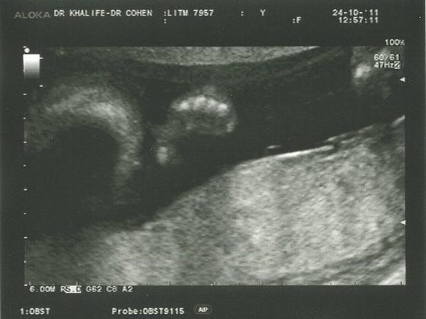 21-week-scan-2-3-3-600x459