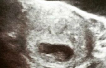 10-week-ultrasound