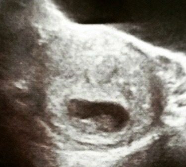 10-week-ultrasound