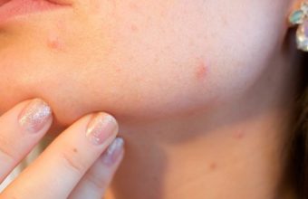 acne-1606765_960_720-600x600