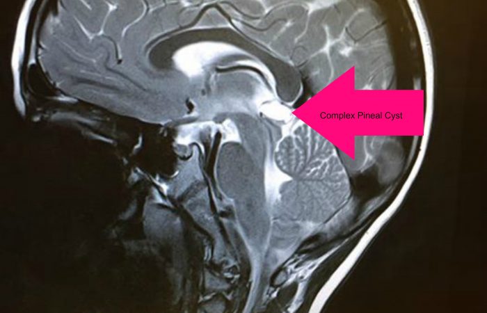 complex pineal cyst