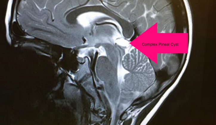 complex pineal cyst